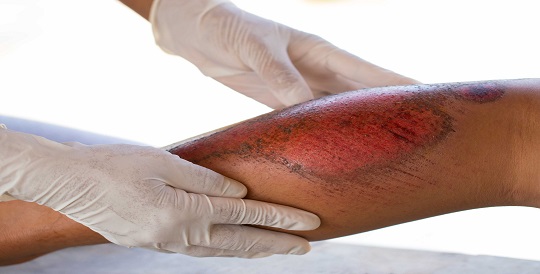 Burn and Scar Management